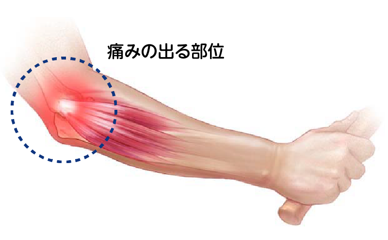 痛みの出る場所