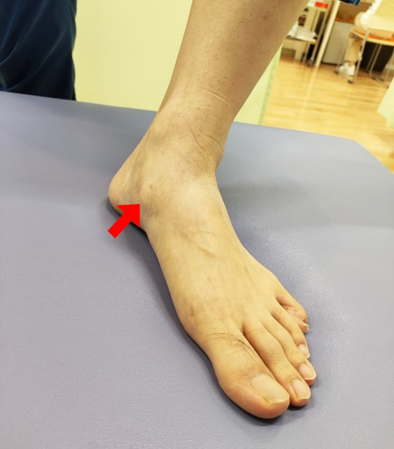 左足内側の外脛骨部