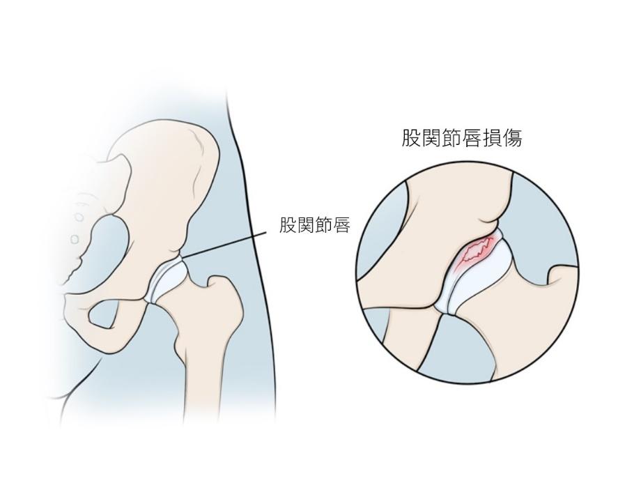 股関節唇損傷