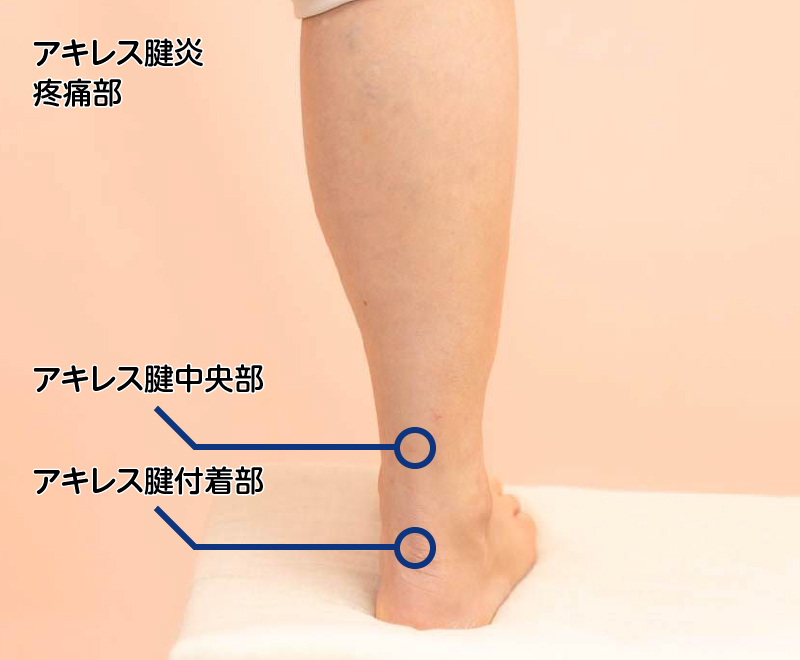 アキレス腱炎疼痛部