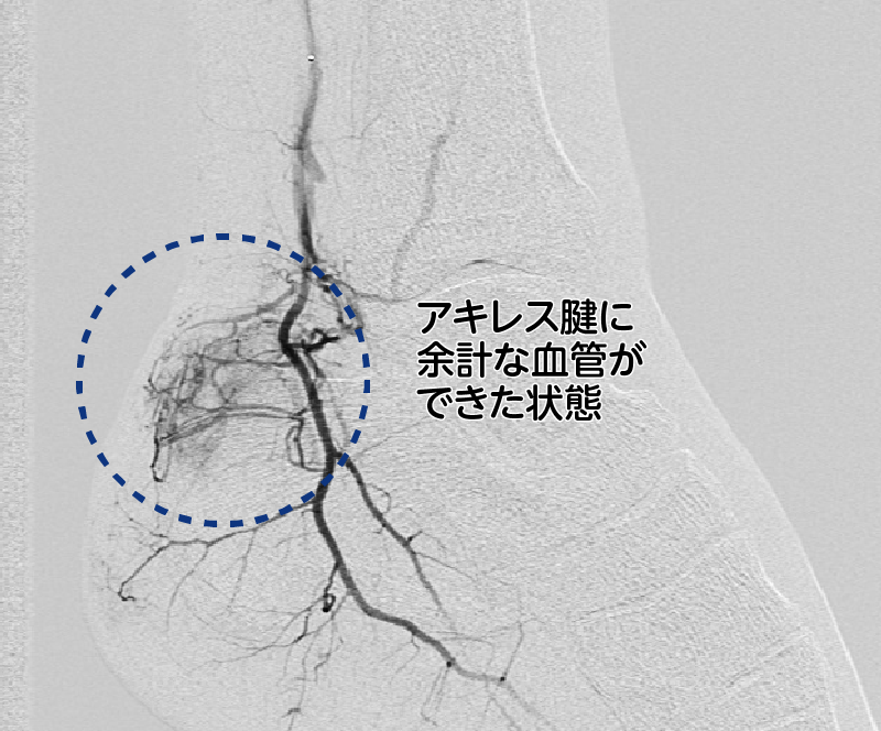 アキレス腱炎の足