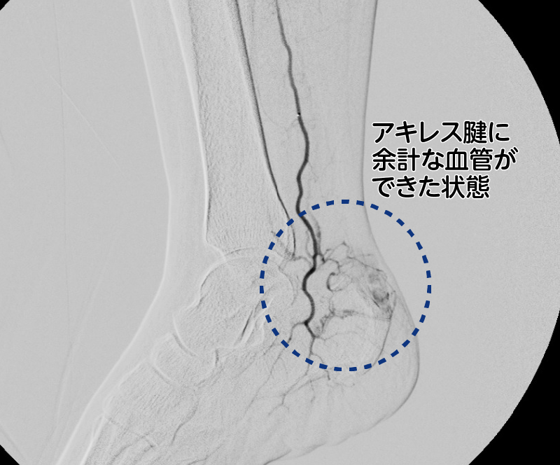 アキレス腱炎の足