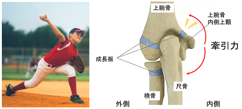 リトルリーグ肘（正式名称：上腕骨内側上顆障害）