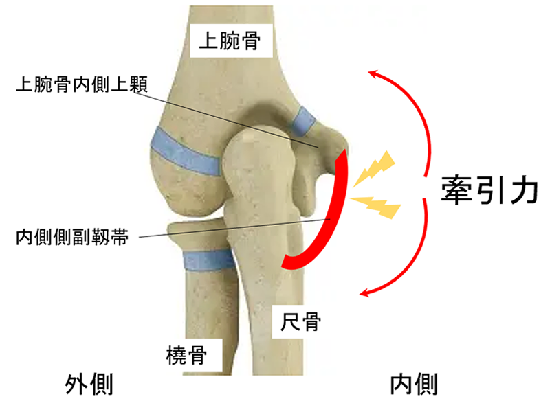 内側側副靭帯損傷（MCL損傷）
