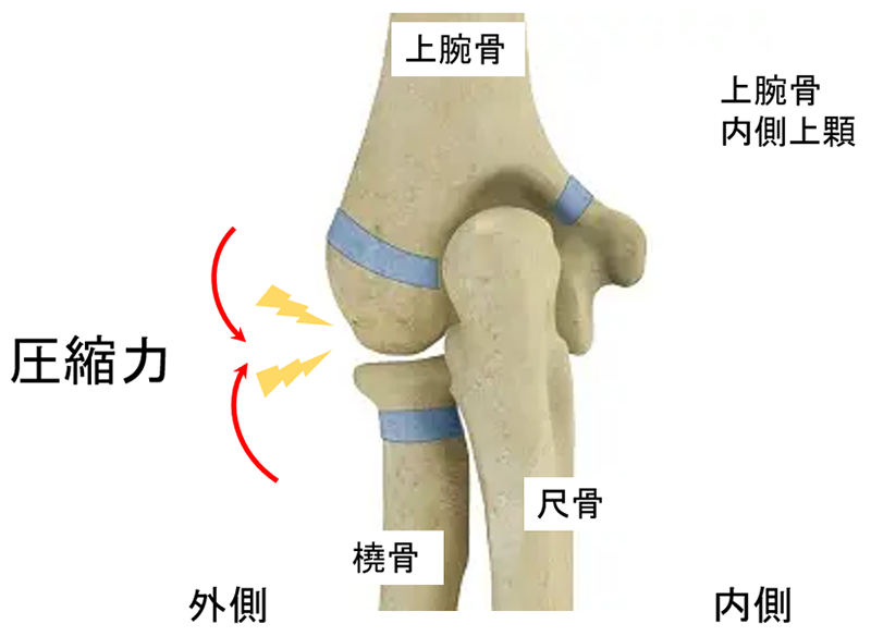 離断性骨軟骨炎（上腕骨小頭障害）