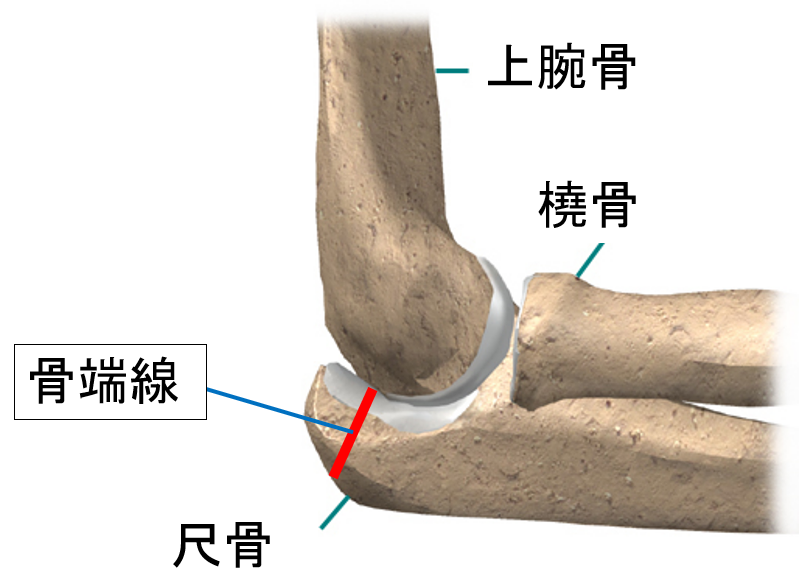 肘頭骨端線解離