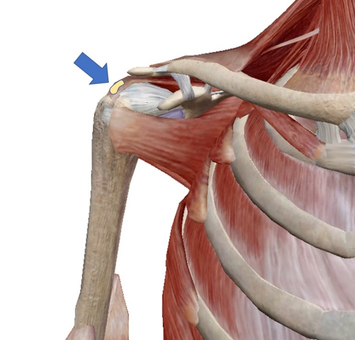 石灰沈着性腱板炎で、石灰の生じやすい肩の部位