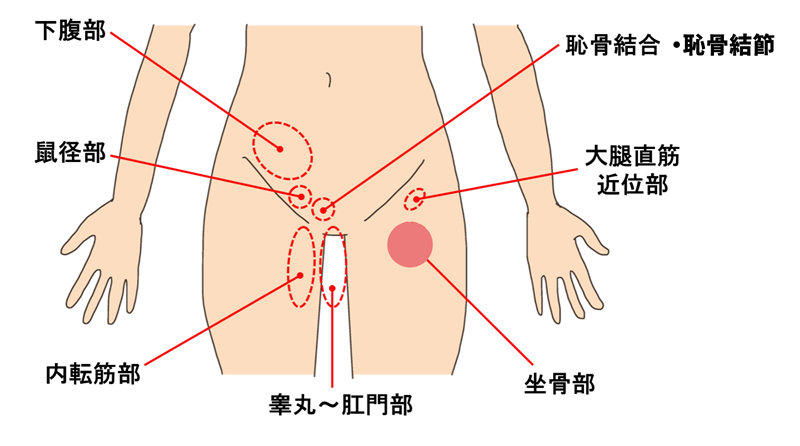 グロインペイン症候群とは