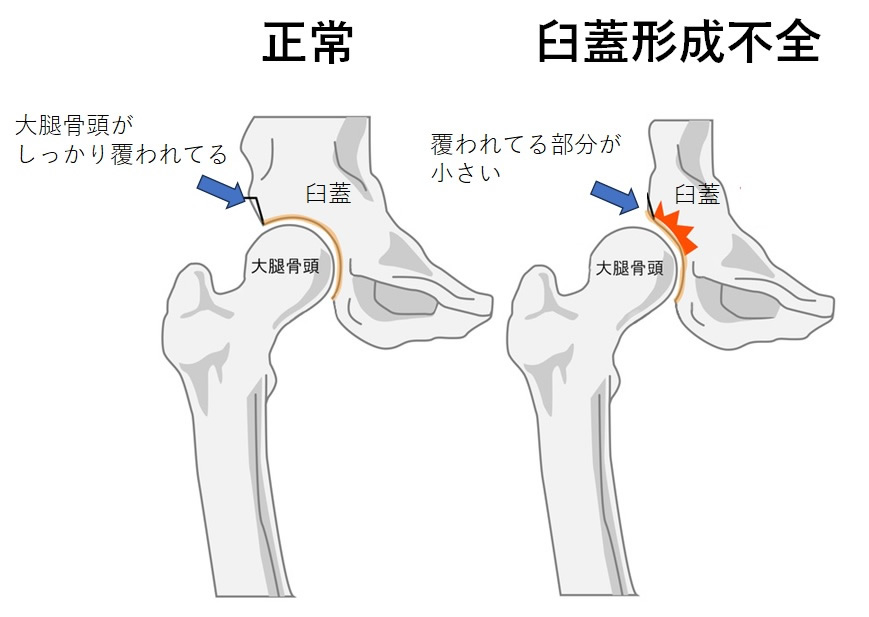 臼蓋形成不全