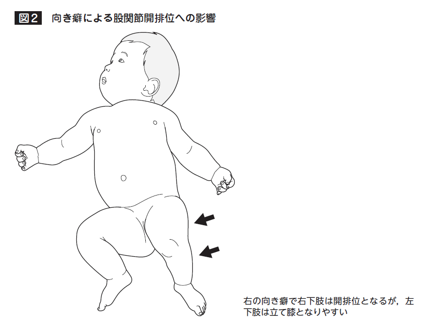 向き癖による股関節開排位への影響