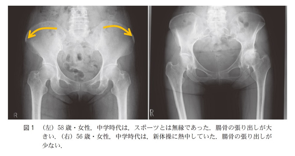 臼蓋形成不全
