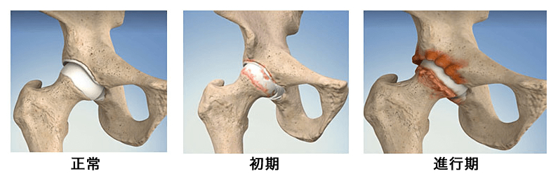 変形性股関節症の進行期