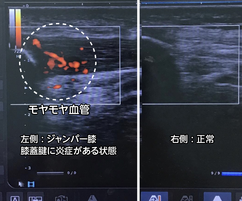 ジャンパー膝のエコー画像