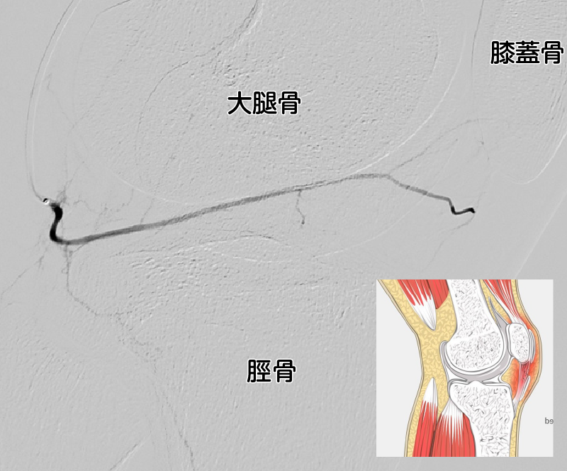 正常な膝の血管