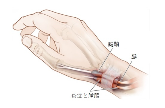 腱鞘炎