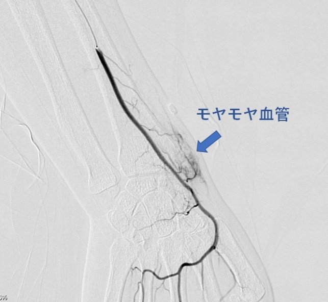 モヤモヤ血管