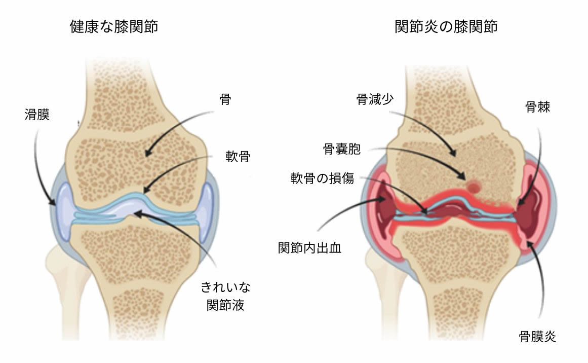 膝関節血腫とは