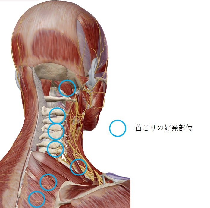 首こりの好発部位