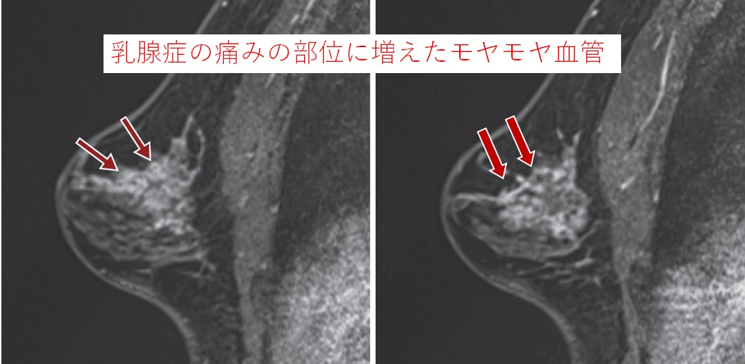 乳腺症の痛みの部位に増えたモヤモヤ血管