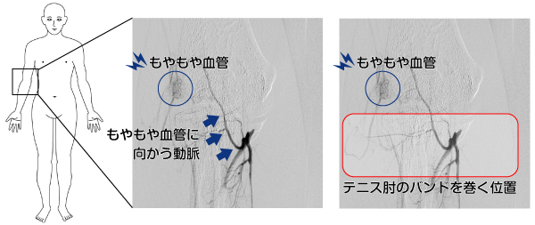 もやもや血管とバンドを巻く位置