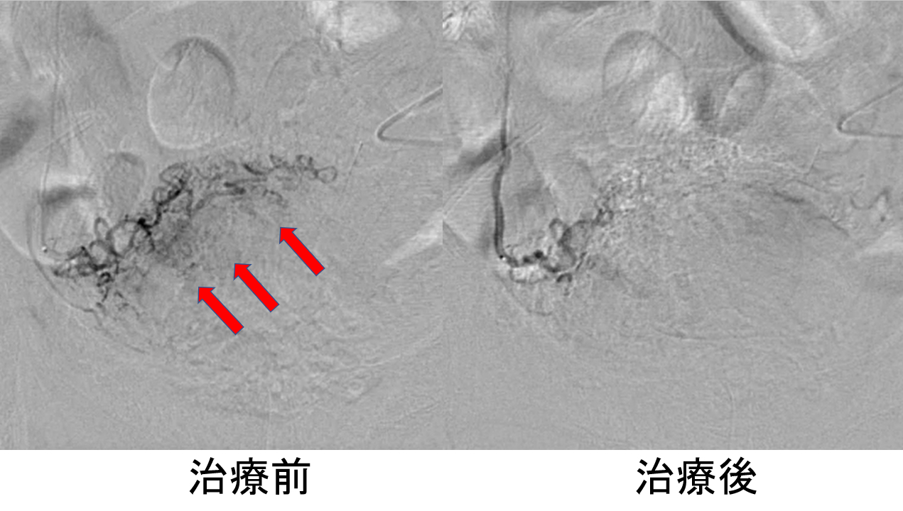 五十肩の血管写真