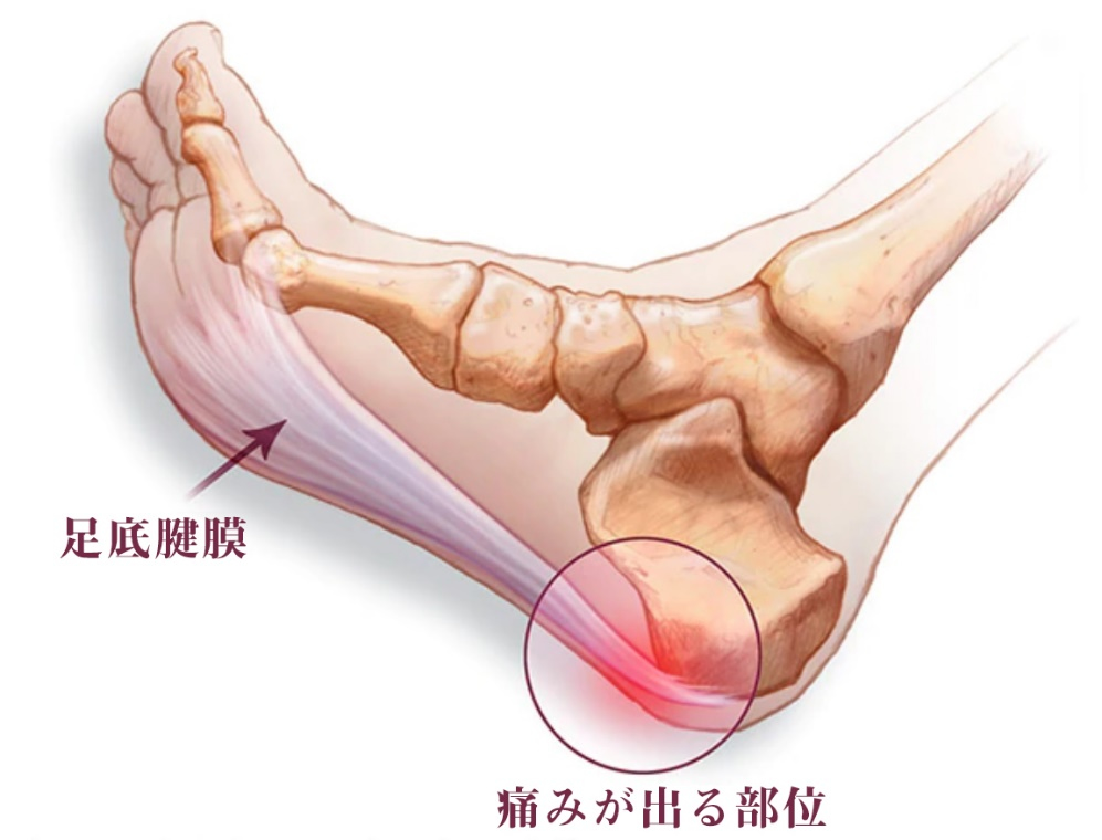 足底腱膜炎