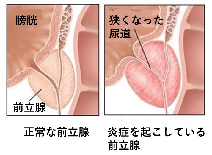 前立腺炎