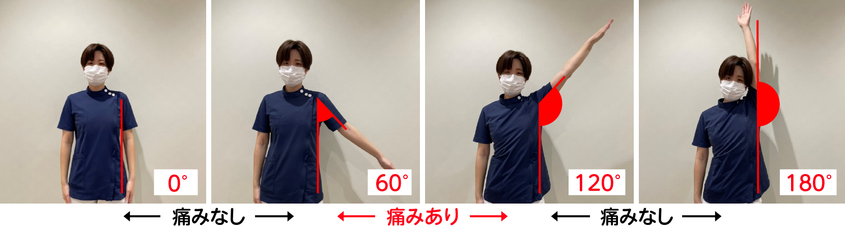 腕を上げていく時に、0°から約60°の間、約120°から180°の間では痛みが出ず、約60°から約120°の間で痛みが出ると腱板断裂の可能性があります。