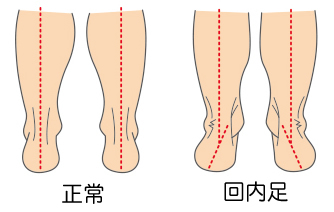 回内足